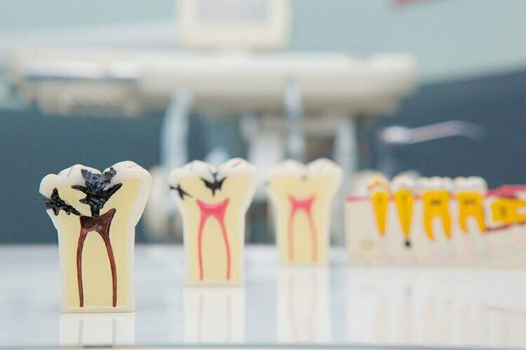 Endodontie (Wurzelkanalbehandlung)