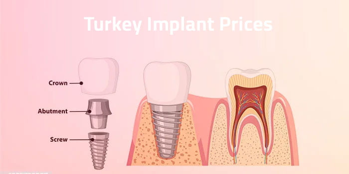 Dental Implant Prices in Turkey (Updated 2024)