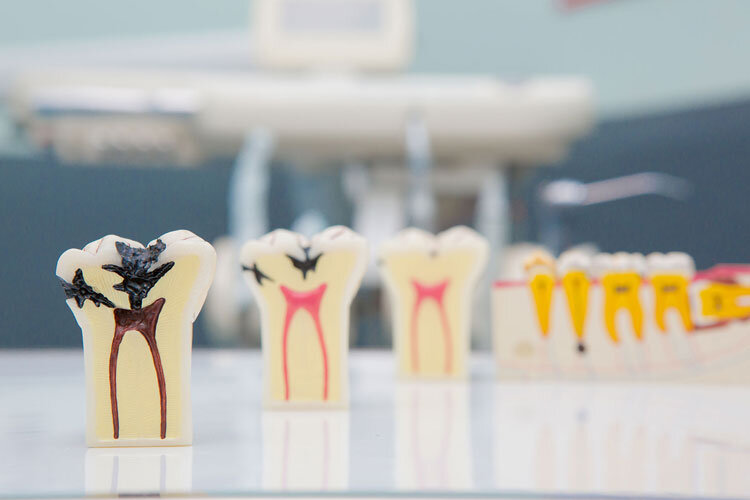 Endodontie (Traitement de canal)