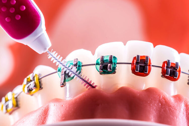 Orthodontie pour le traitement des dents mal alignées et tordues