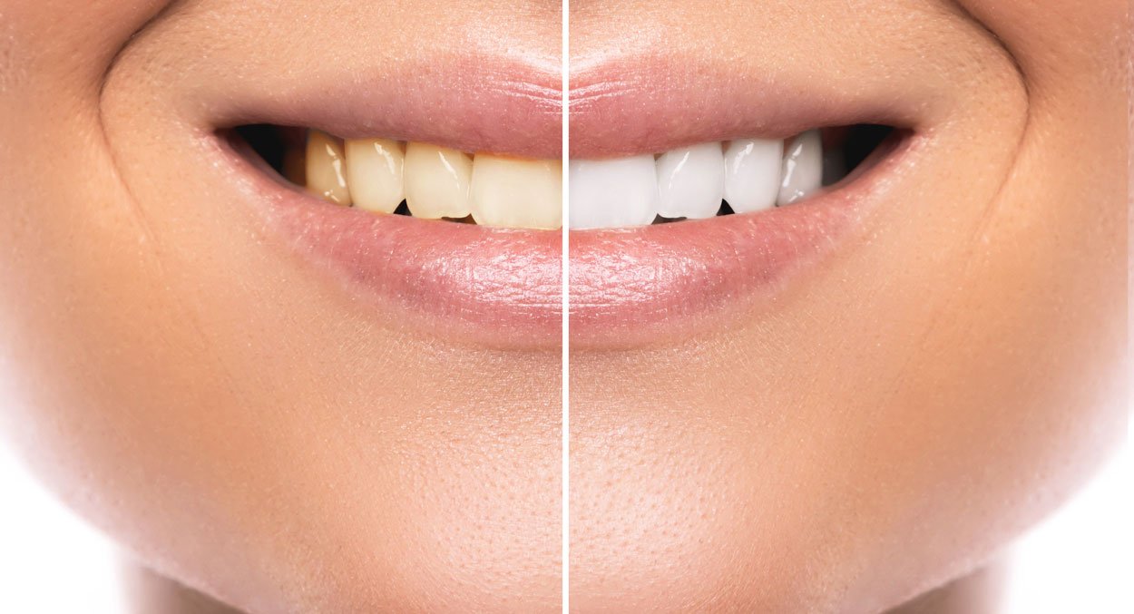 Oncesi-sonrasi dental merkez ağız ve diş sağlığı merkezi Dental merkez ağız ve diş sağlığı merkezi