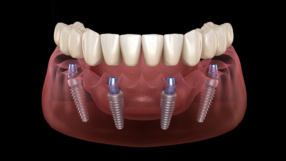 All-on-four-implant dental merkez ağız ve diş sağlığı merkezi Dental merkez ağız ve diş sağlığı merkezi