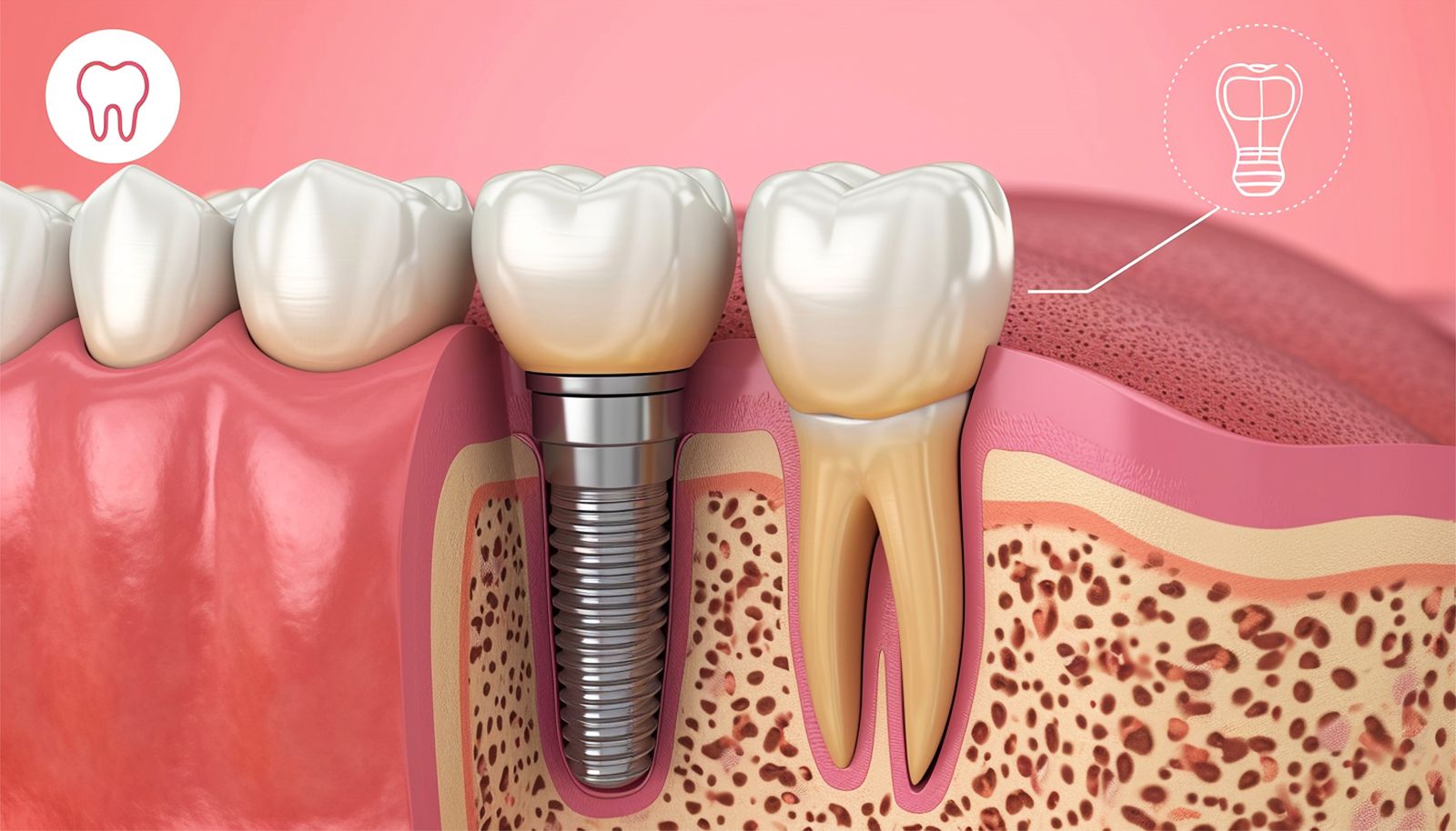 Implant-cesitleri-nelerdir dental merkez ağız ve diş sağlığı merkezi Dental merkez ağız ve diş sağlığı merkezi