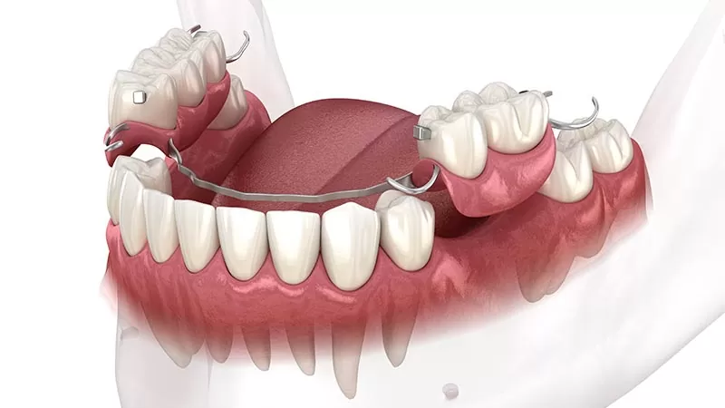 Parsiyel-protez-dis-cesitleri dental merkez ağız ve diş sağlığı merkezi Dental merkez ağız ve diş sağlığı merkezi