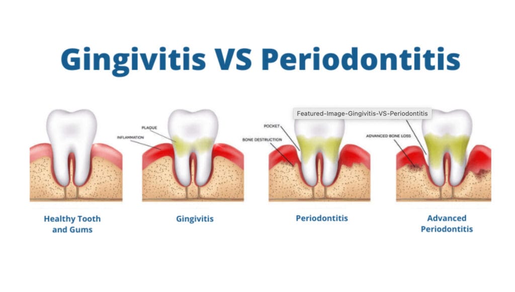 Diş Eti Tedavisi Gebze ( Gingivit ve Periodontit)