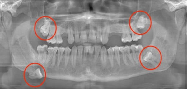 Sinire-yakin-gomulu-dis dental merkez ağız ve diş sağlığı merkezi Dental merkez ağız ve diş sağlığı merkezi