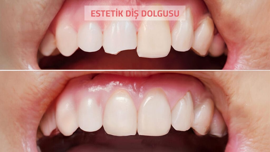 Estetik Diş Dolgusu Nedir, Sadece Ön Dişlere mi Yapılır?