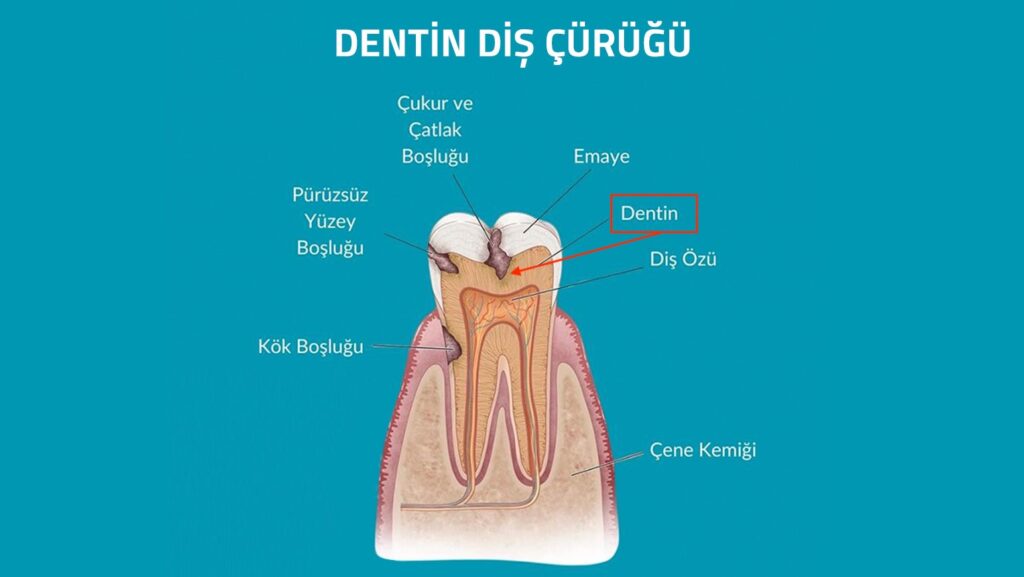 Dentin Diş Çürüğü Nedir, Tedavisi Nasıl Yapılır?
