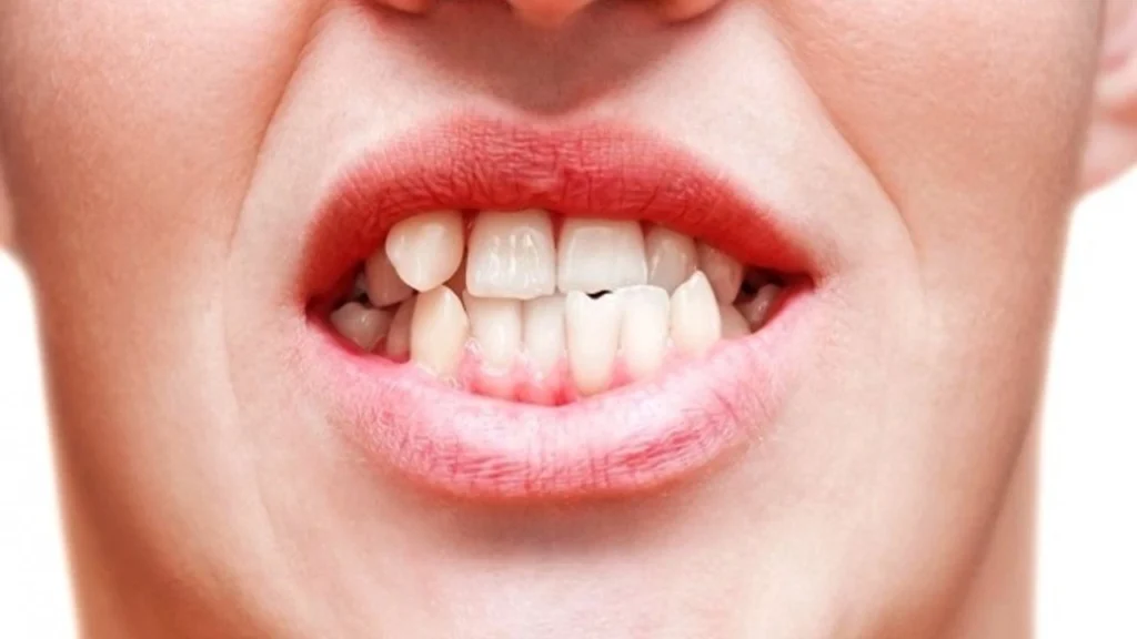 Diş teli kullanmadan tedavi dental merkez ağız ve diş sağlığı merkezi