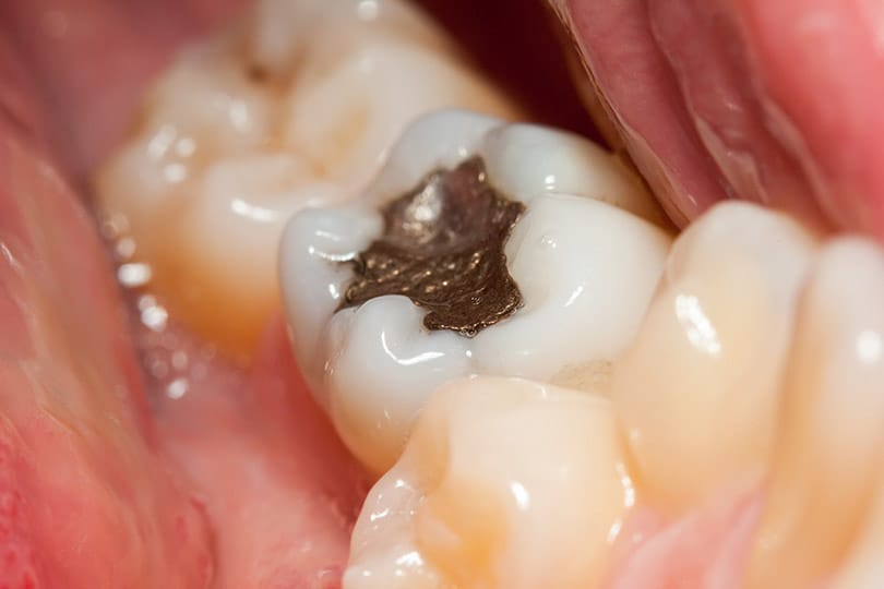 Diş Dolgusu İstemeden Yutulursa Ne Olur? (Amalgam – Geçici)
